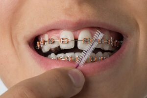 cavities orthodontic treatment